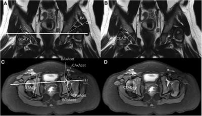 Analysis of the association between the acetabular morphology and femoral head in children aged 0–3 years with developmental hip dysplasia